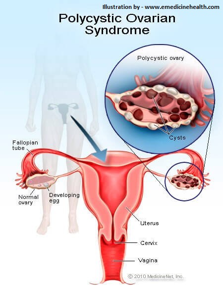 PCOS – Polycysytic ovarian syndrome or disease